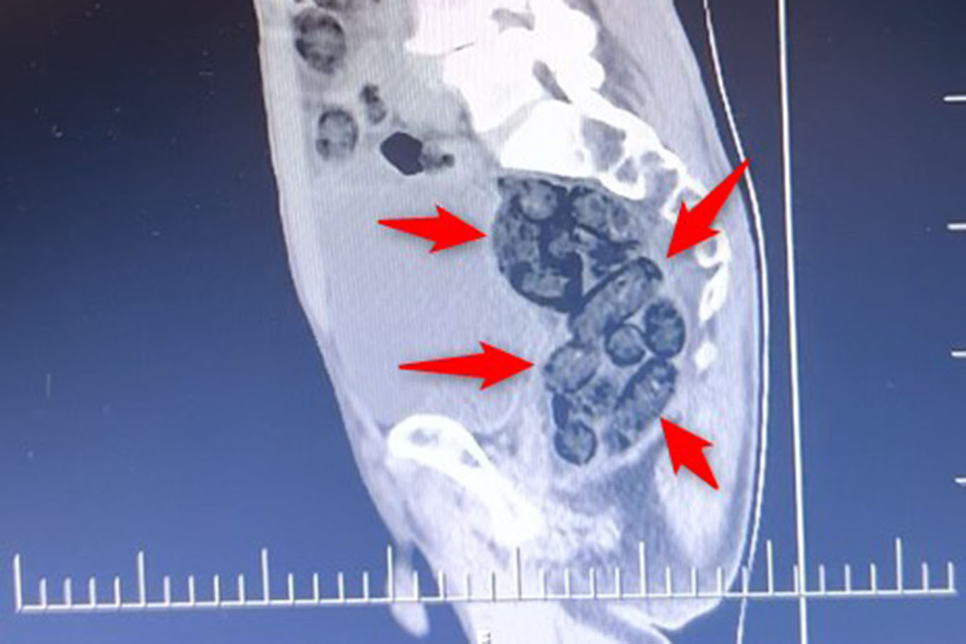 Midesinde yardım kilo uyuşturucu taşıdı